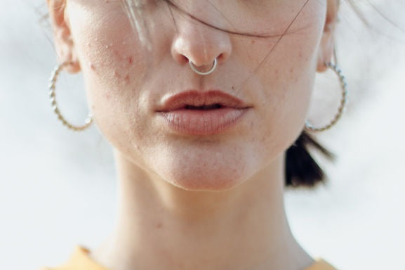 How To Beat Stress Acne When Stress Has The Upper Hand